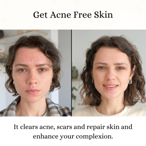 Get Acne Free Skin