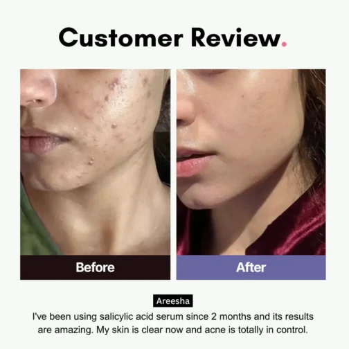 Before and After results using Anti Acne Serum Salicylic Acid + B5 in Pakistan – Clear Skin Transformation