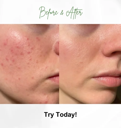 Before and After using Lemon Facewash